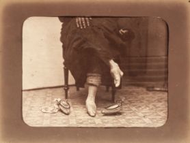 China. A Chinese woman’s bound feet, by William Saunders, c. 1870