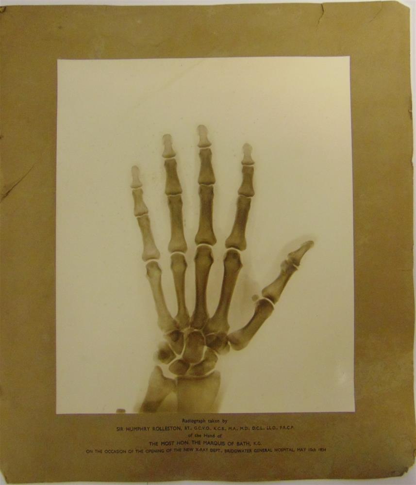 A RADIOGRAPH [X-RAY] TAKEN BY SIR HUMPHREY ROLLESTON, OF THE HAND OF THE MARQUIS OF BATH on the - Image 2 of 2