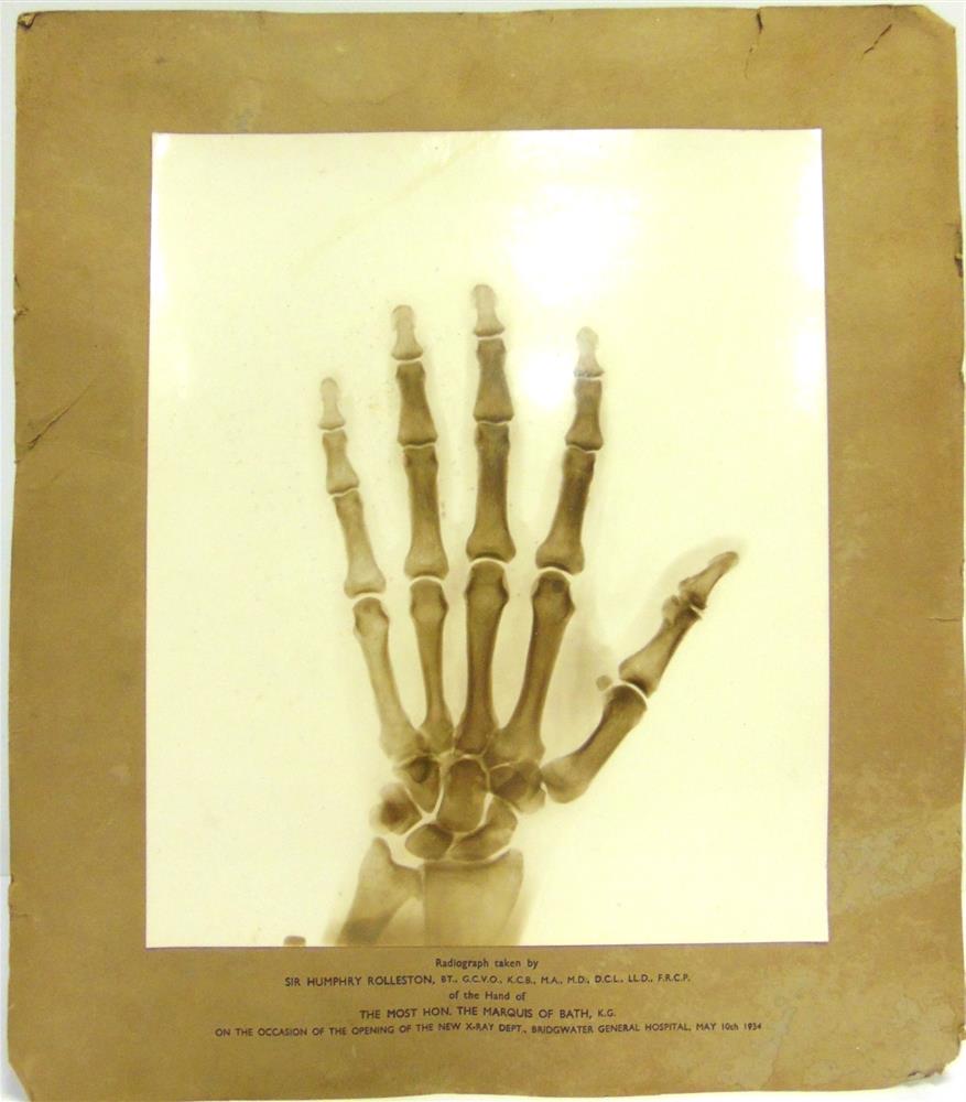 A RADIOGRAPH [X-RAY] TAKEN BY SIR HUMPHREY ROLLESTON, OF THE HAND OF THE MARQUIS OF BATH on the