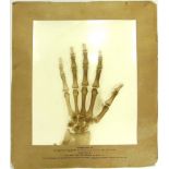 A RADIOGRAPH [X-RAY] TAKEN BY SIR HUMPHREY ROLLESTON, OF THE HAND OF THE MARQUIS OF BATH on the