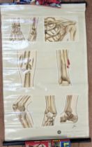 St John's Ambulance educational poster: 'Fractures (stained) 87cm x 54cm